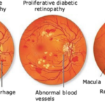 alt="AI-Powered Research Links Retinal Thickness to Early Detection of Diabetes, Dementia"