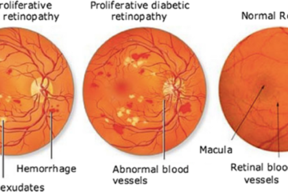 alt="AI-Powered Research Links Retinal Thickness to Early Detection of Diabetes, Dementia"