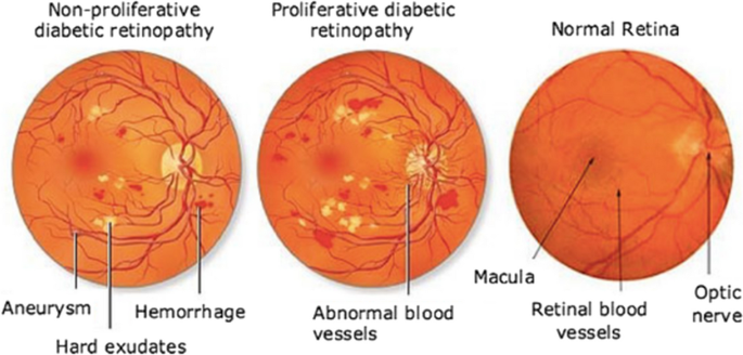 alt="AI-Powered Research Links Retinal Thickness to Early Detection of Diabetes, Dementia"