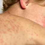 alt="US Deals with 21st Century's Worst Measles Epidemic"