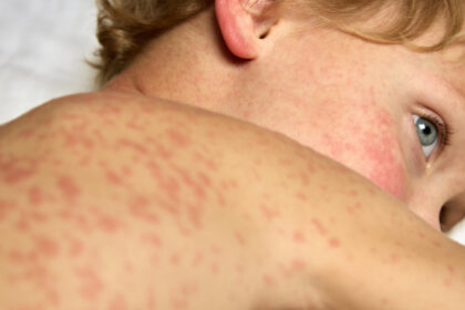 alt="US Deals with 21st Century's Worst Measles Epidemic"