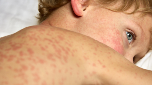 alt="US Deals with 21st Century's Worst Measles Epidemic"