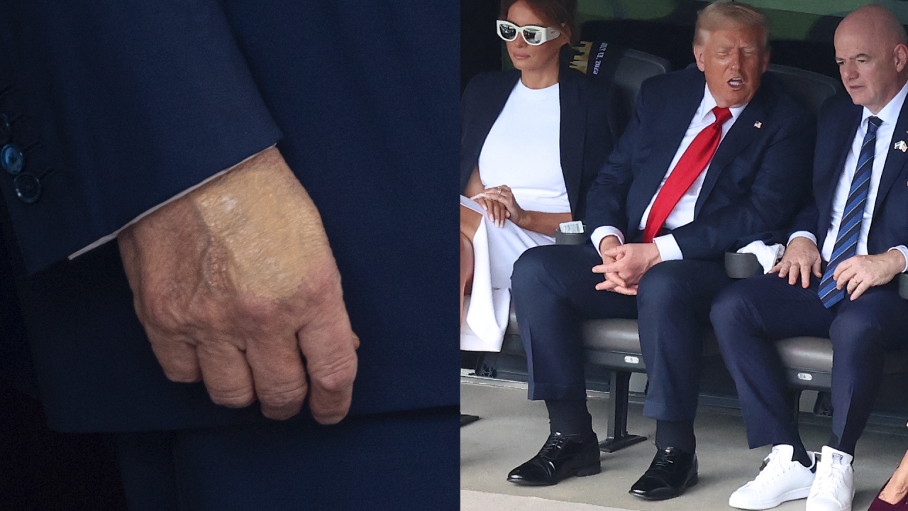 alt="Donald Trump's Leg Illness Draws Attention to UAE Workers' Risks"